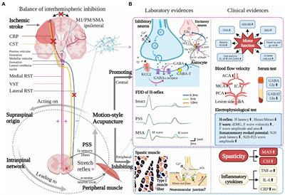 New insights into acupuncture techniques for poststroke spasticity